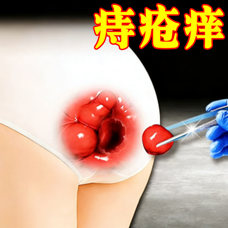痔痣疮久坐肛门痒大便出血内痔外痔混合痔肉球外用软膏