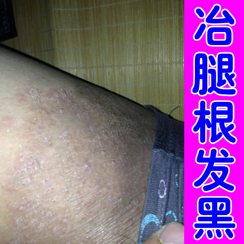 大腿内侧黑色素沉淀去腿两侧干燥粗糙黑外用修复除屁股臀部私处黑
