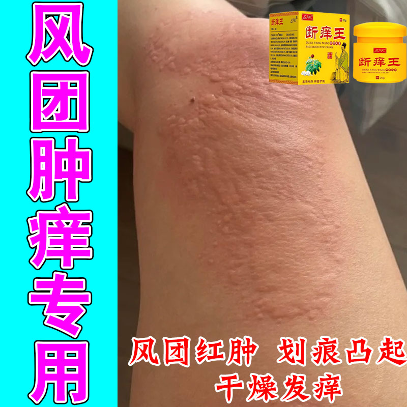 手臂身上风团疙瘩发痒大面积抓挠划痕凸起红肿皮肤发痒修护膏