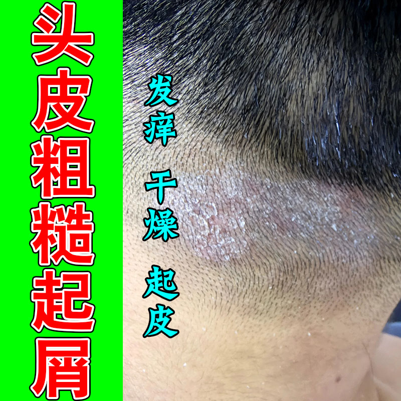 头皮白屑起皮干燥粗糙发痒泛红头部肌肤舒缓保湿植物膏