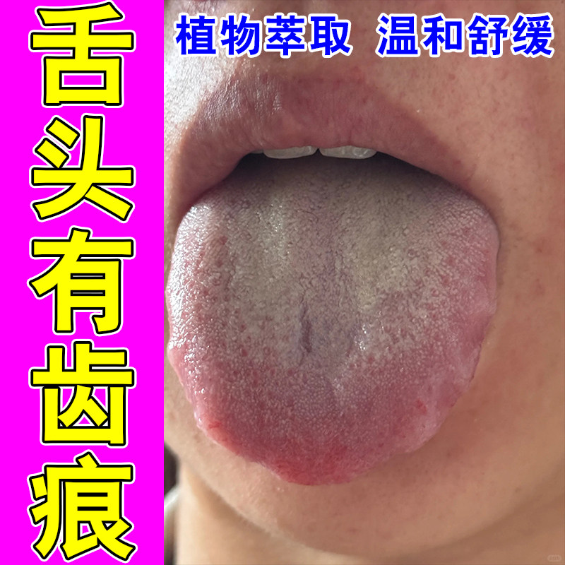 舌苔白厚厚腻发黄口臭口干口苦舌燥发腻体内湿气重草本舒缓喷剂