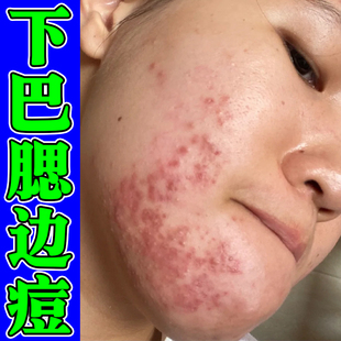淋巴腮边长疙瘩外用药脸颊脓包疙瘩下巴脸颊两侧长豆乳膏