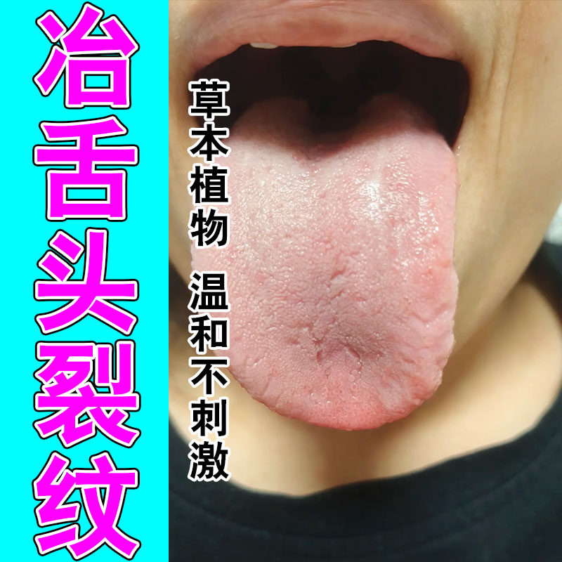 舌头裂纹中间有裂痕舌齿痕调理灼口舌苔发白厚腻草本修护喷雾剂
