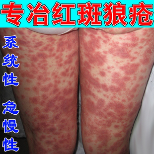 红斑狼疮膏药皮肤丘大红斑红点皮肤长红斑疙瘩