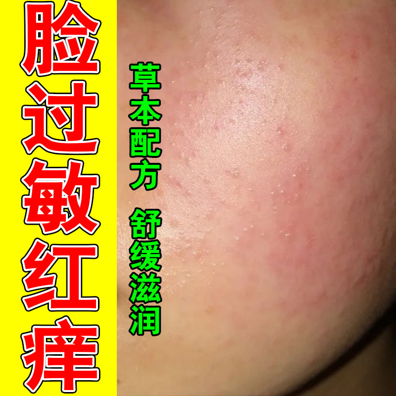 面部换季泛红干痒红肿刺痛春秋肌肤敏感发烫植物萃取修护膏