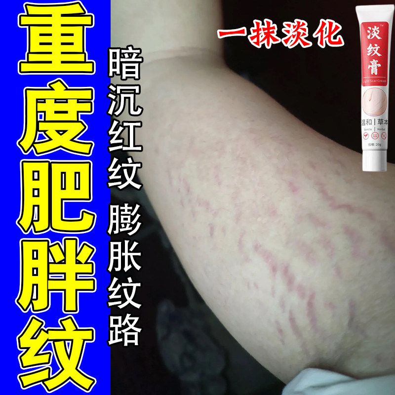 肥胖纹生长纹消大腿学生成人腿上肥胖纹淡化白色纹路修护乳膏