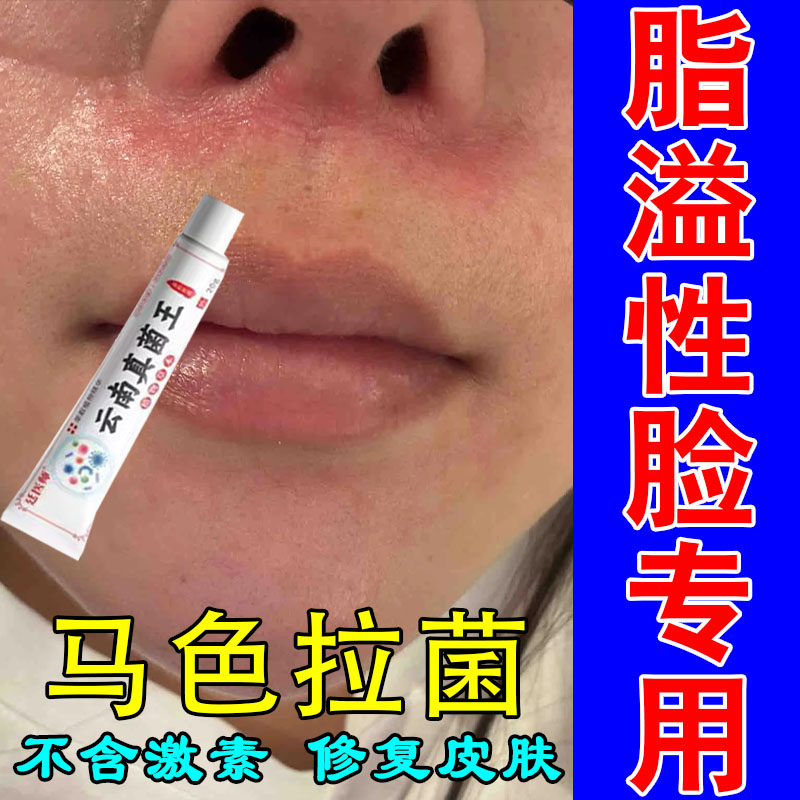 鼻子脂溢性皮肤泛红起皮鼻子发红干燥皮痒脂溢性泛红植物萃取软膏