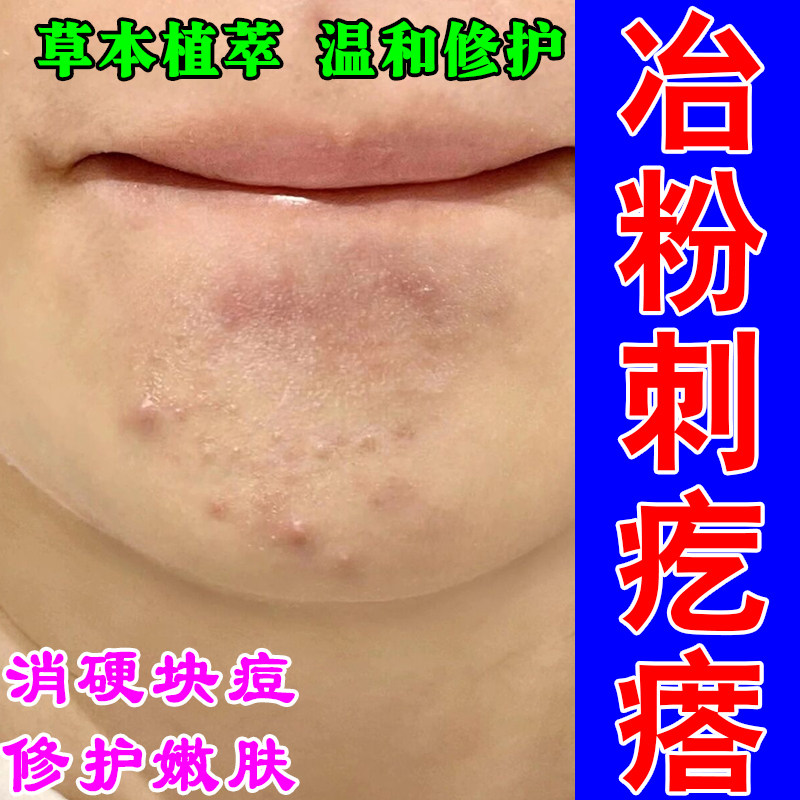去严重下巴痘闭口粉刺修复脸上小疙瘩颗粒痘草本修护乳膏霜