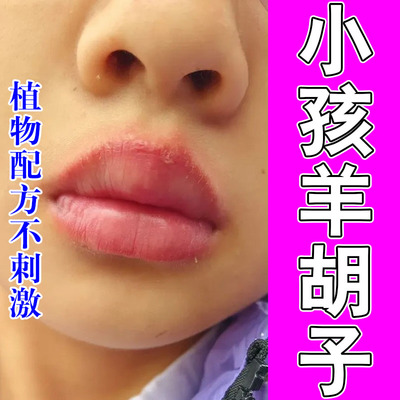 小孩嘴巴一圈羊胡子泛红结痂干疼舔嘴起皮不适草本润肤保湿软霜