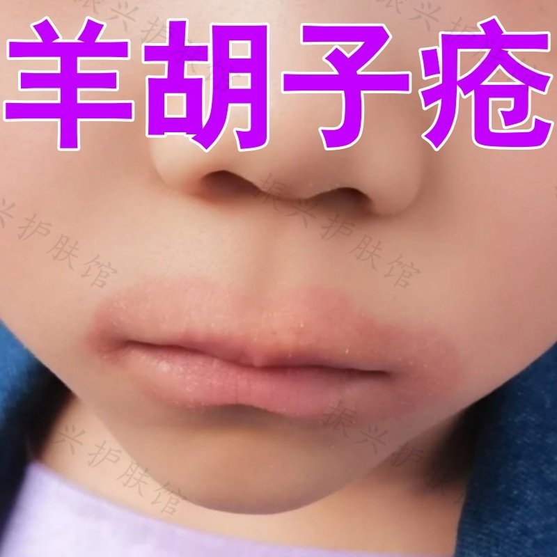 羊胡子疮【小孩唇周红】儿童舔嘴唇唇周发炎上火嘴烂起水泡润唇膏