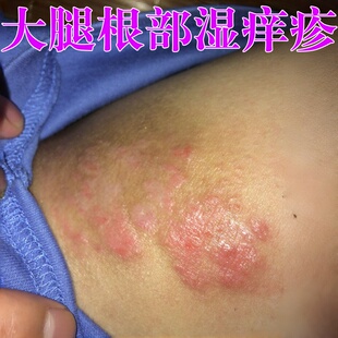 大腿根部痒股藓止痒根去男士裤裆潮湿有异味真菌顽固皮肤炎外用药