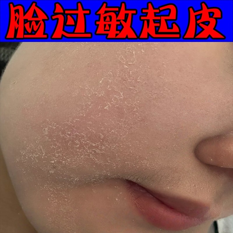 【过敏干燥起皮】脸干掉皮