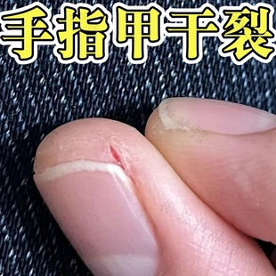 指甲裂开修复手指头裂口子出血秋冬皮肤皴裂干燥流血接触性皮肤炎