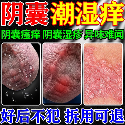 阴囊潮湿瘙痒男性专用膏药