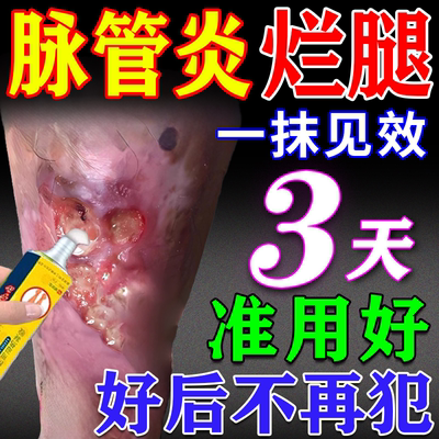 脉管炎老烂腿专用膏药好后不犯