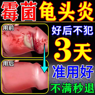 霉菌性龟头包皮炎专用膏药男性私处真菌感染红斑红点消炎杀菌喷剂