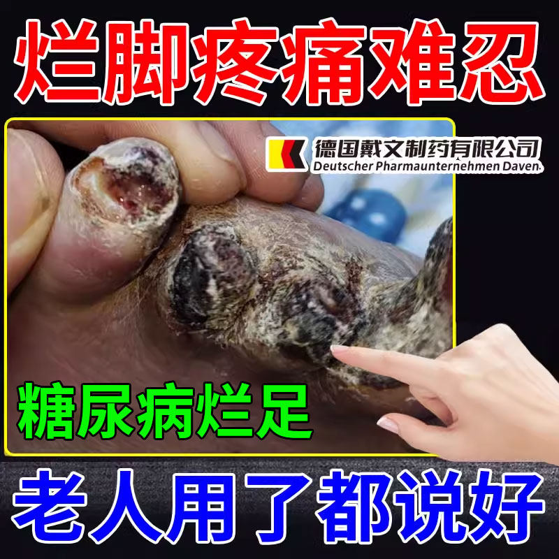 烂脚疼痛难忍糖尿病烂足皮肤溃烂腿脚专用膏药伤口愈合促进长肉ah
