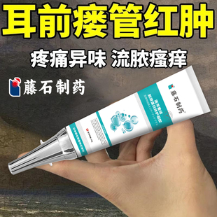 耳前瘘管红肿疼痛异味流脓瘙痒发炎异味鼓包无需手术拔毒AH