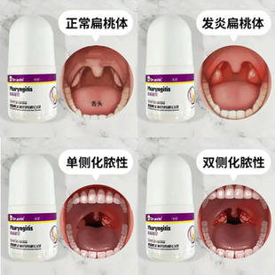 扁桃体发炎化脓性专喉咙肿痛用肿大喷雾剂儿童急慢咽喉药房同售AH
