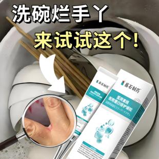 手指缝溃烂痒洗碗手丫发红蜕皮用专真菌感染小疙瘩瘙痒药房同售YK