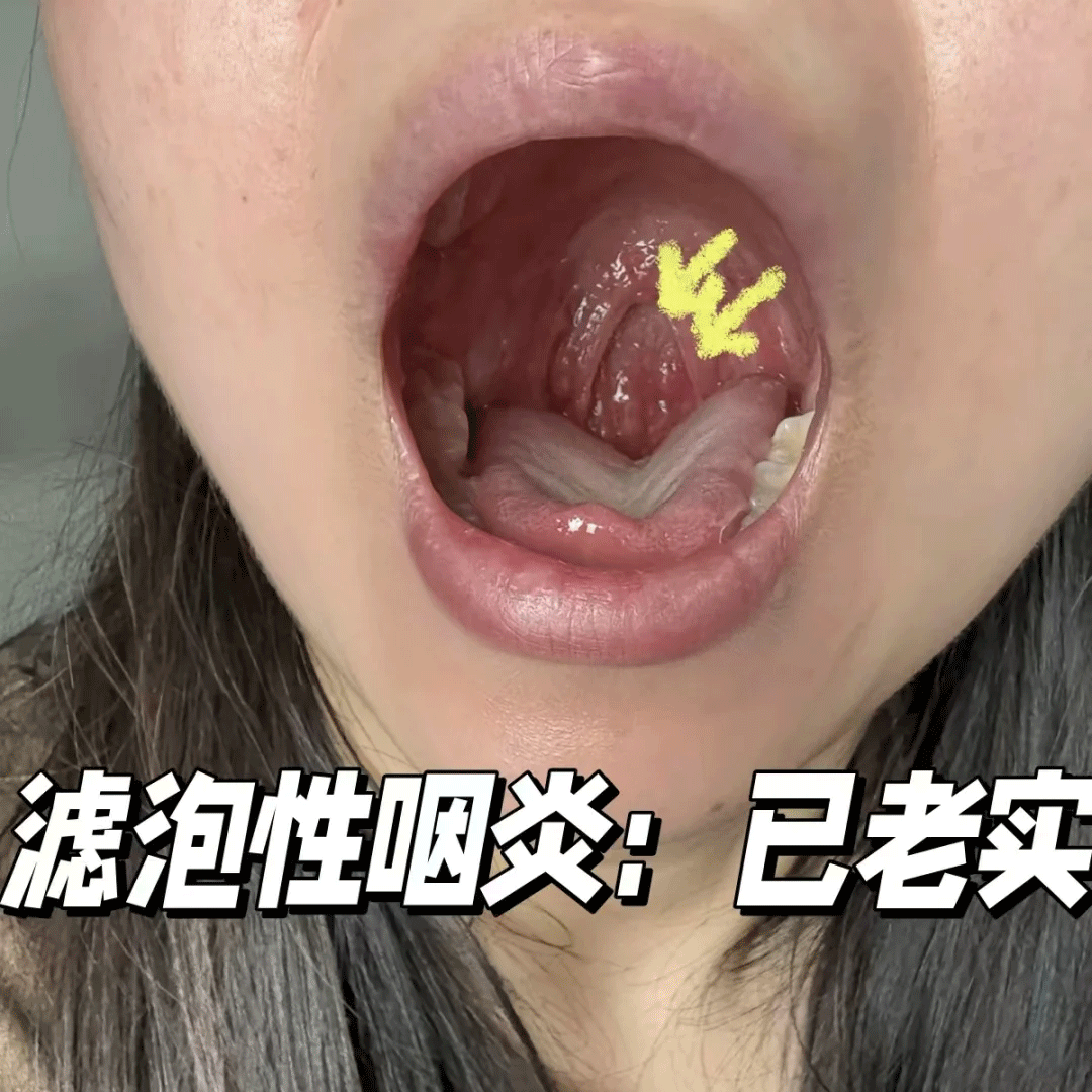 藤石制药滤泡性咽炎慢性咽炎淋巴滤泡增生喉咙肿痛干痒异物感AH