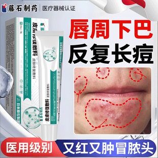 唇周下巴反复长痘姨妈痘硬块痘石头痘红肿脓包熬夜痘监备案膏AH