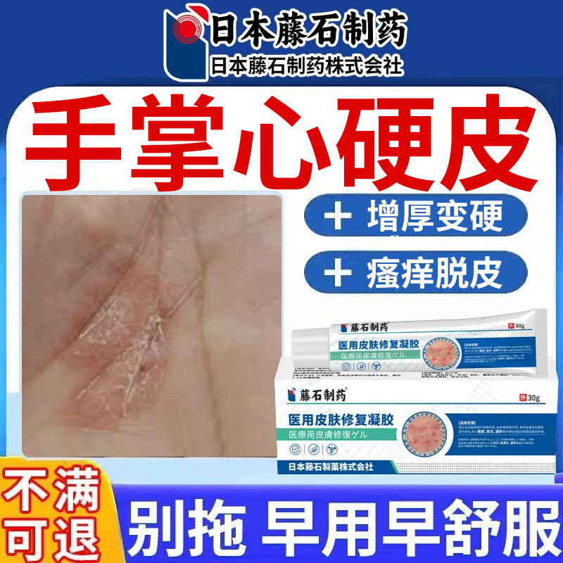 手掌心硬皮增厚变硬瘙痒脱皮用