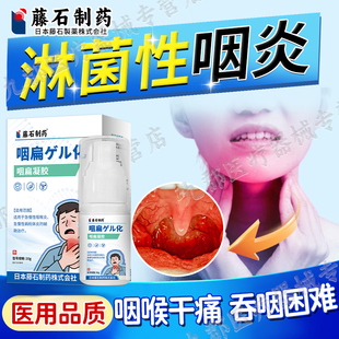 淋菌性咽喉炎口后嗓子吞咽疼痛咽喉干痒刀片嗓急性扁桃体炎化脓AH