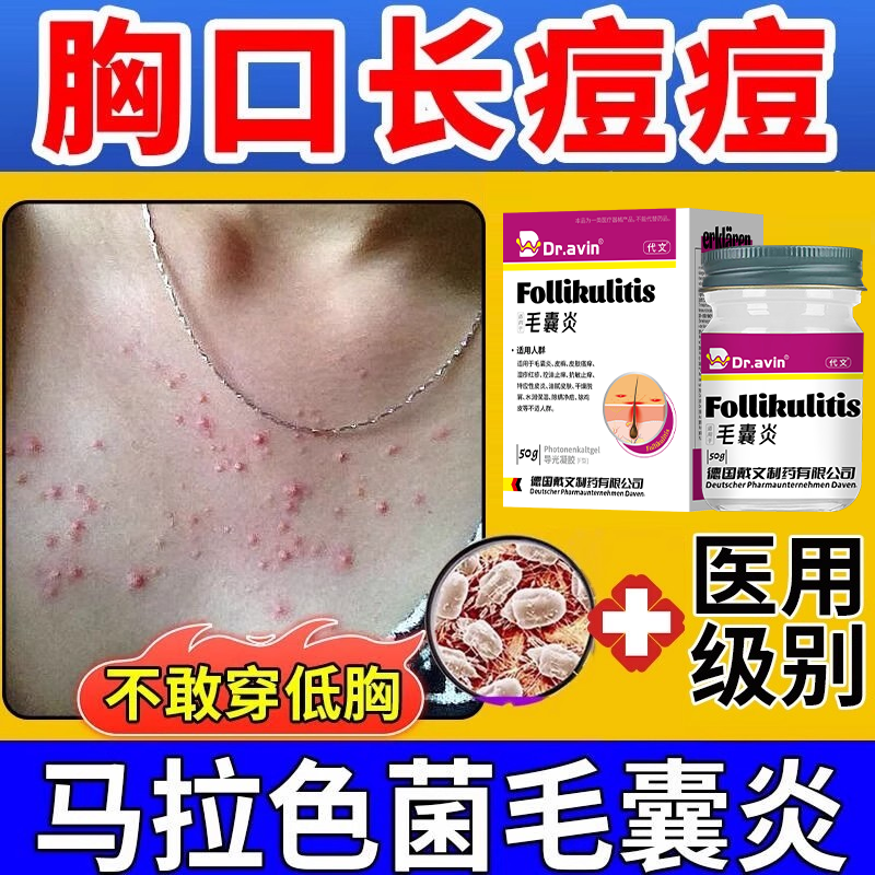 胸口长痘痘背后胸口马色拉菌毛囊炎膏鸡皮肤粉刺红点瘙痒长痘AH