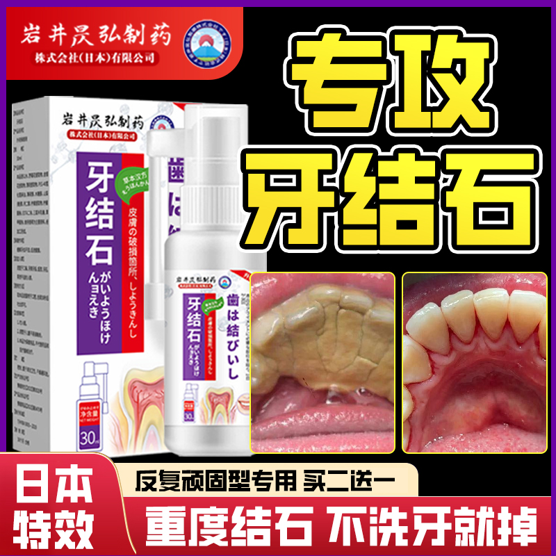 牙结石溶解喷雾牙渍污垢黄牙齿口臭神器速清理效非医用美白日本特