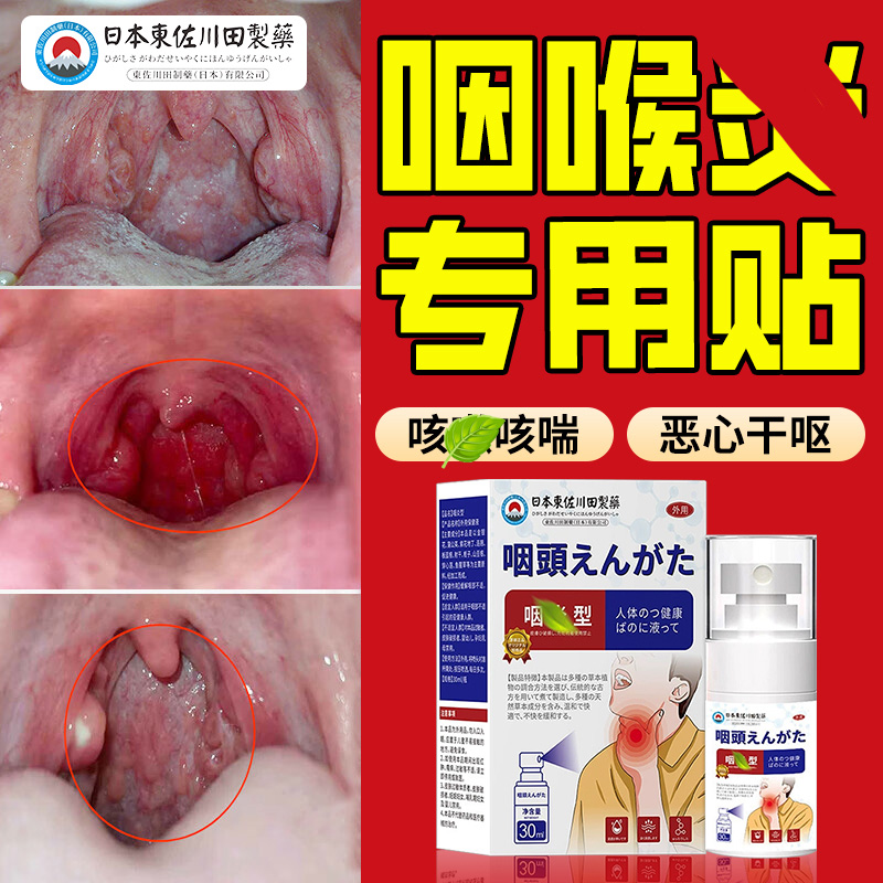 慢性咽喉咙痒咳化异物感止痰咳干痒咽扁特滤泡增生效喷雾剂