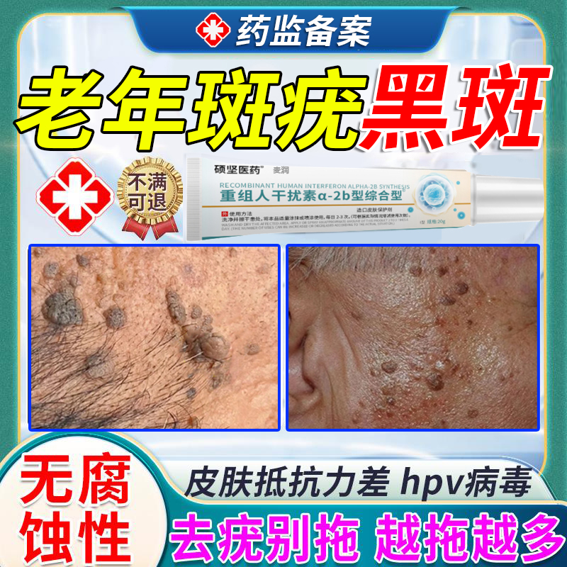 老人疣脸上扁平疣专用老年斑增厚凸起肉粒疙瘩一抹灵黑斑去除膏AY
