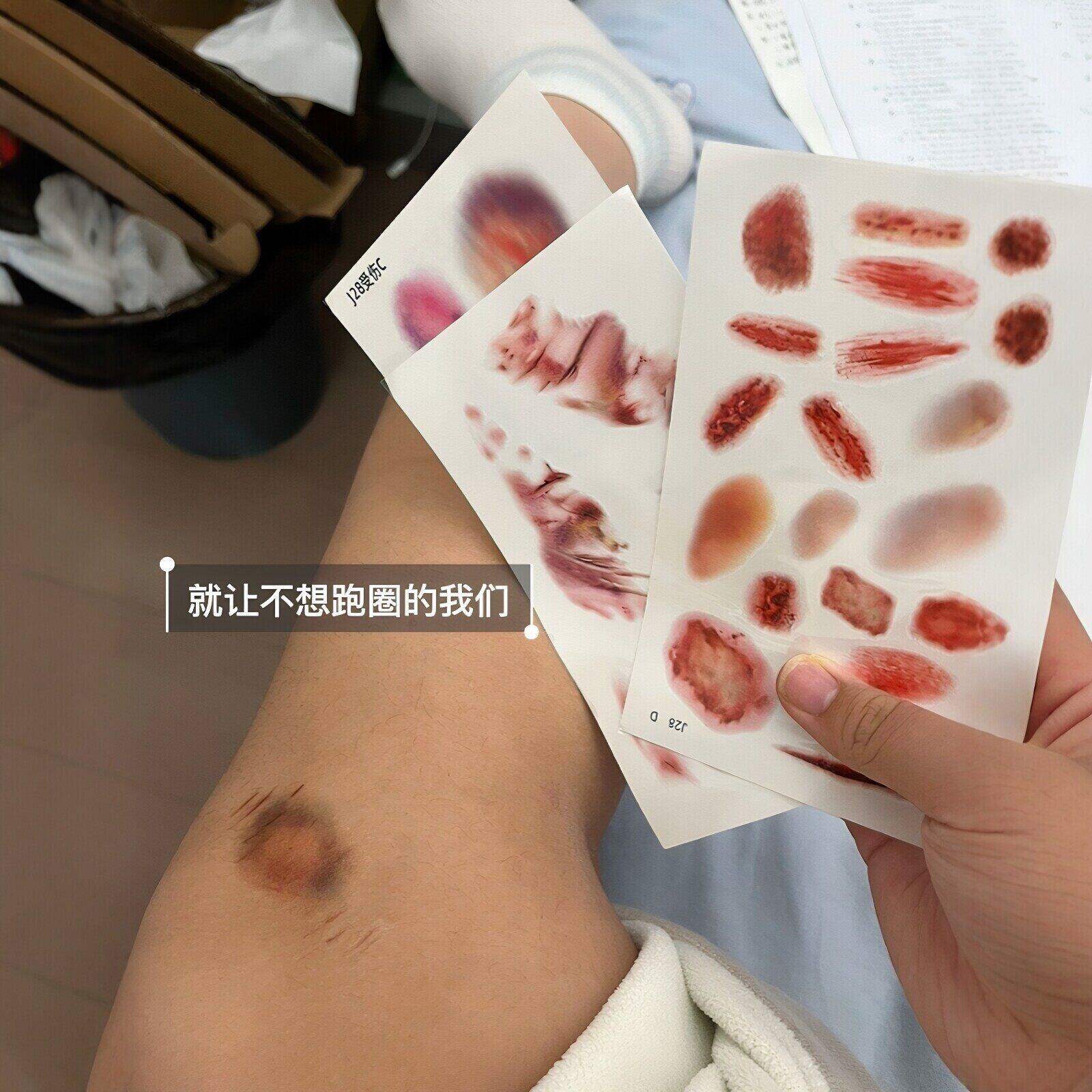 逼真3D淤青疤痕贴纸请假整蛊