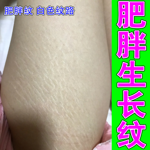 去肥胖纹修复霜生长纹消除大腿学生腰腹上肥胖纹去除男女通用软膏