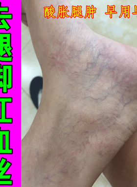 冶腿上红血丝明显小腿青筋扩张下肢腿部发胀腿面网状红丝腿部不适