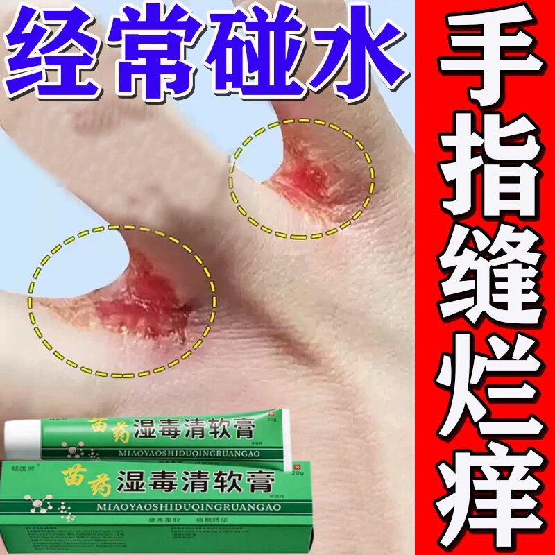 手指缝痒起皮洗碗杀鱼经常碰水手指缝开裂发红脱皮指间痒