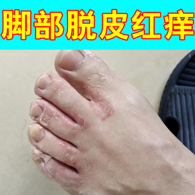 脚部脱皮红痒掉屑发红泛白脚臭出汗脚趾缝裂开感染起水泡修护保湿