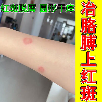 冶胳膊上红斑猫咪传染人患皮肤痒皮肤红肿掉屑起皮专用修复药乳膏