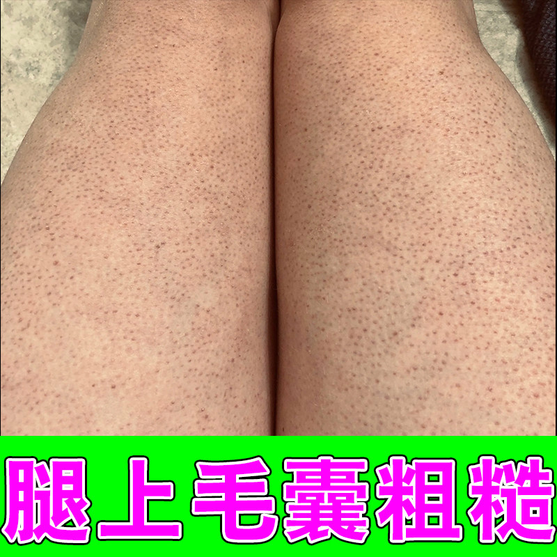 腿上毛囊粗糙毛孔粗大堵塞毛周角皮肤消毒护理（消）