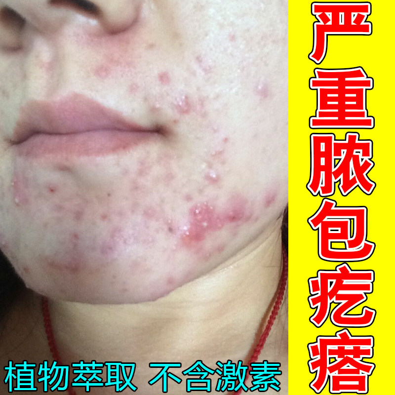 严重脓包疙瘩脸上长痘逆光闭口粉刺额头痘痘过敏上火专用修复药乳