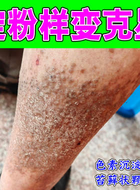淀粉样变顽固后背黑色素沉淀褐色斑点剧烈痒胳膊小腿干痒真菌感染