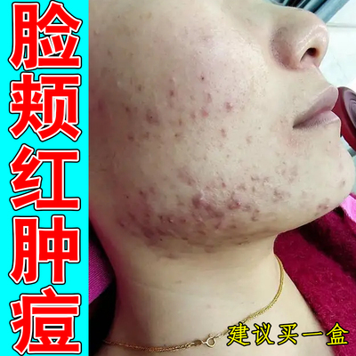 脸颊红肿痘粗糙脸上过敏干燥内分泌失调上火熬夜痘青春痘专用修护