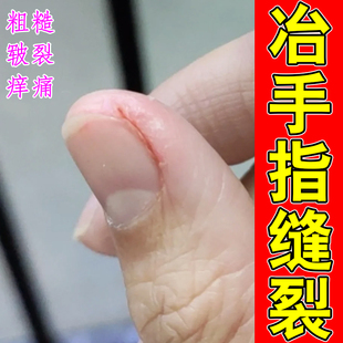 冶手指缝裂手脱皮红肿手指开裂指甲缝开裂专用秋冬防裂修复药乳膏