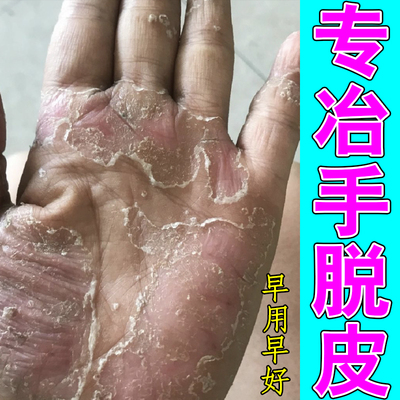 专冶手脱皮严重干燥粗糙红肿裂口手足蜕皮手掌蜕皮缺乏维生素保湿