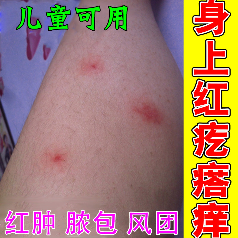 天热身上痒小腿胳膊起小红疙瘩红点点脖子出汗痒全身皮肤痒膏药