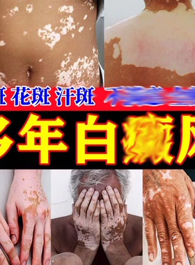 复方补骨脂酊白膏风快速消白斑专外用黑色素生长中成药偏方