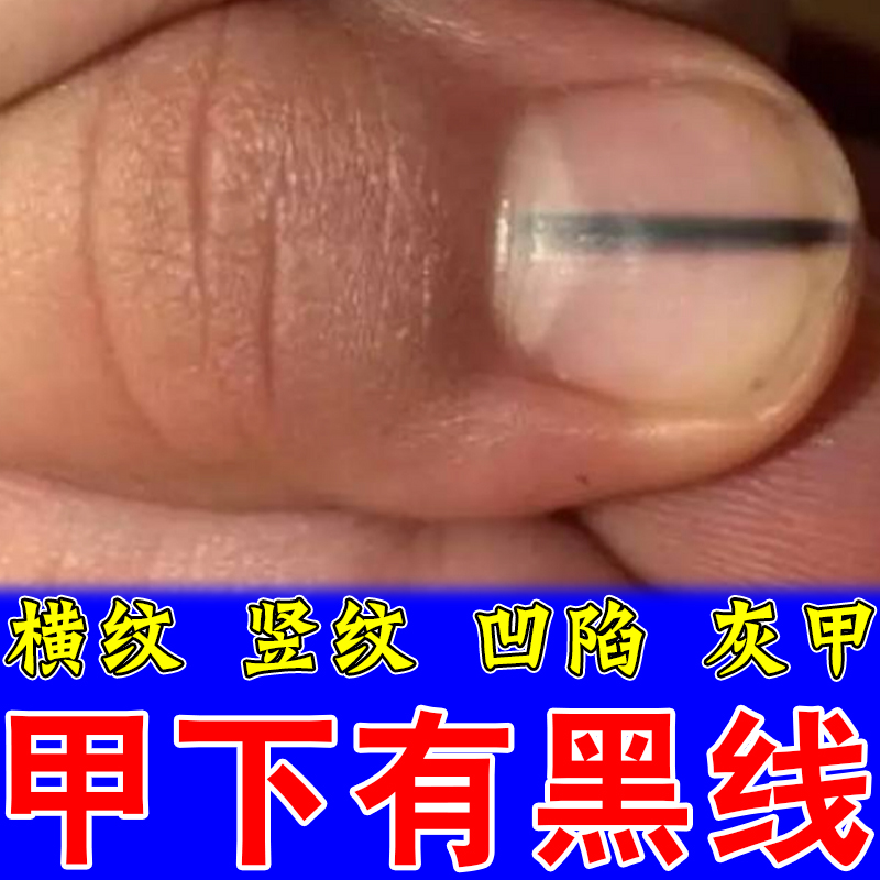 指甲黑线甲母痣疼痛甲下出血药乳
