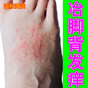 冶发脚面起疹子干燥起皮皮肤粗糙起红点水泡脚过敏修护霜