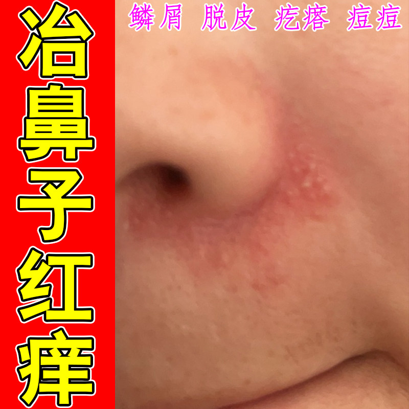 冶鼻子红痒鼻子两侧发红脱皮鼻翼两边泛红干燥起皮掉皮酒糟鼻红痒