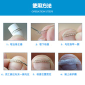 正甲贴嵌甲矫正器脚趾甲贴片不C锈钢正甲丝专业矫正修脚工具